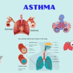 Asthma: Types, Causes, Symptoms, Diagnosis & Treatment