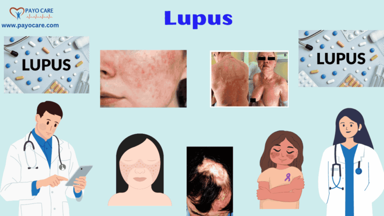 Lupus :Types, Causes, Symptoms, Prevention, Diagnosis & Treatment