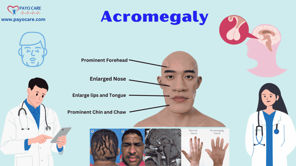 Acromegaly: Types, Causes, Symptoms, Prevention & Treatment