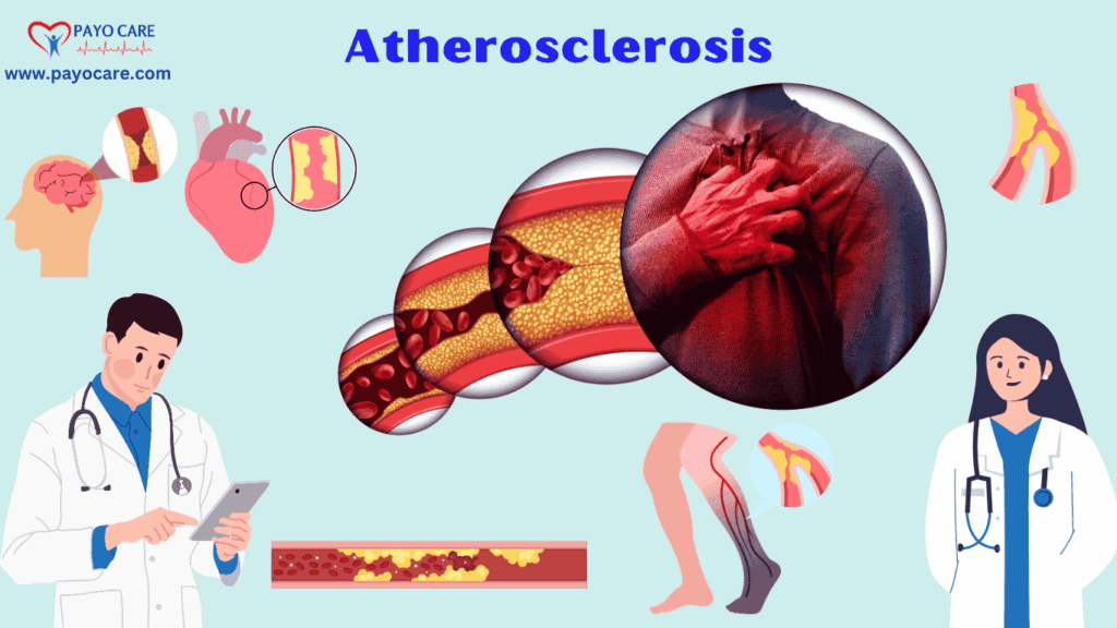 Atherosclerosis :Types, Causes, Symptoms, Prevention, Diagnosis & Treatment