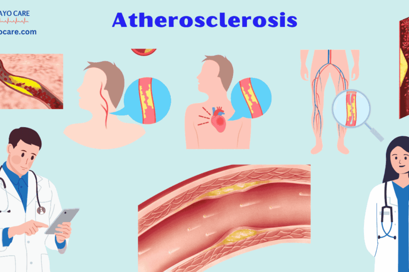 Atherosclerosis :Causes, Symptoms & Treatment