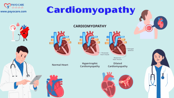 .Cardiomyopathy :Types, Causes, Symptoms, Prevention, Diagnosis & Treatment
