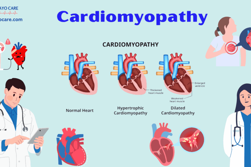 Cardiomyopathy :Causes, Symptoms, Prevention & Treatment