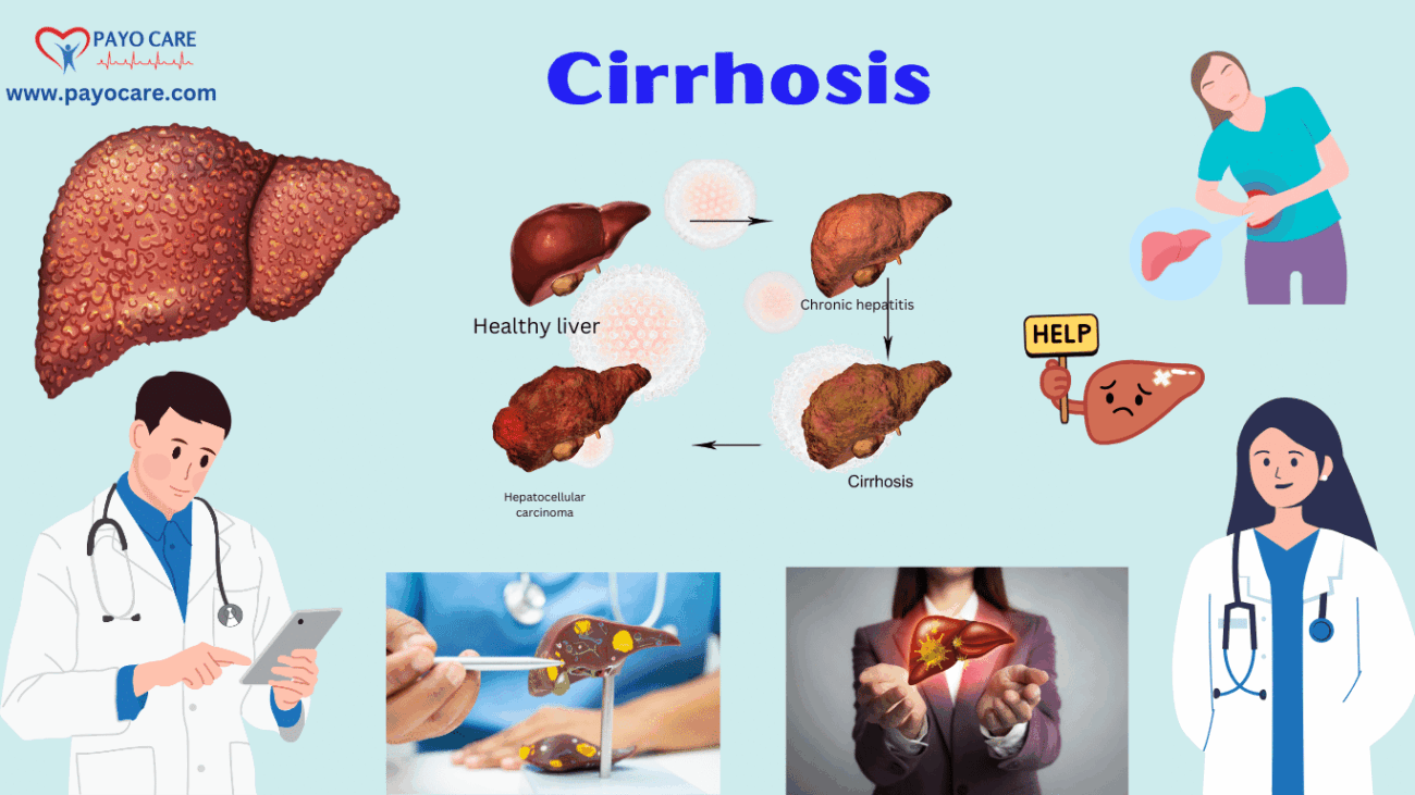 Cirrhosis: Types, Causes, Symptoms, Prevention, Diagnosis & Treatment