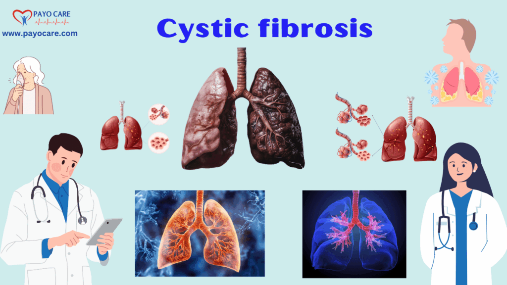 Cystic Fibrosis: Types, Causes, Symptoms, Prevention, Diagnosis & Treatment Cystic Fibrosis: Types, Causes, Symptoms, Prevention, Diagnosis & Treatment