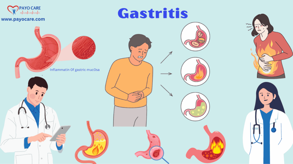 Gastritis: Types, Causes, Symptoms, Prevention,