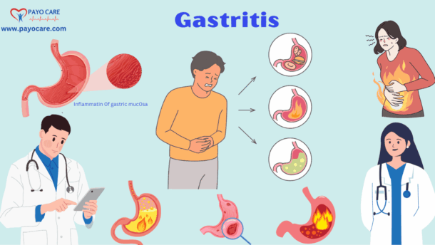 Gastritis: Types, Causes, Symptoms, Prevention,