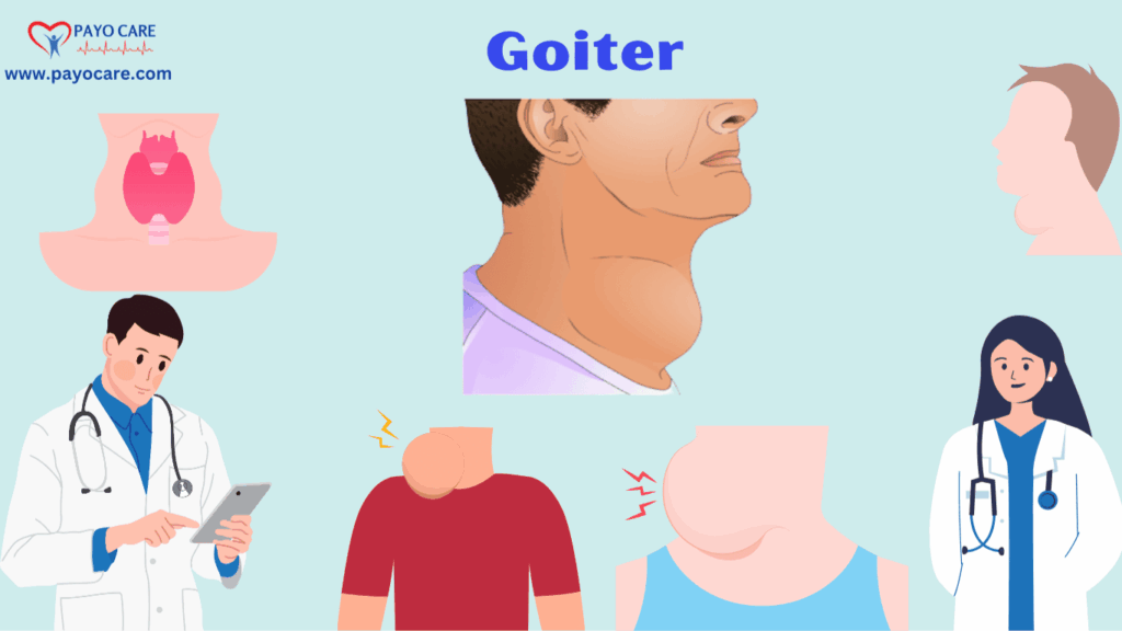 Goiter: Types, Causes, Symptoms, Prevention, Diagnosis, and Treatments Goiter: Types, Causes, Symptoms, Prevention, Diagnosis, and Treatments