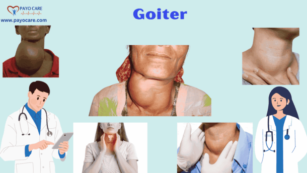 Goiter: Types, Causes, Symptoms, Prevention,