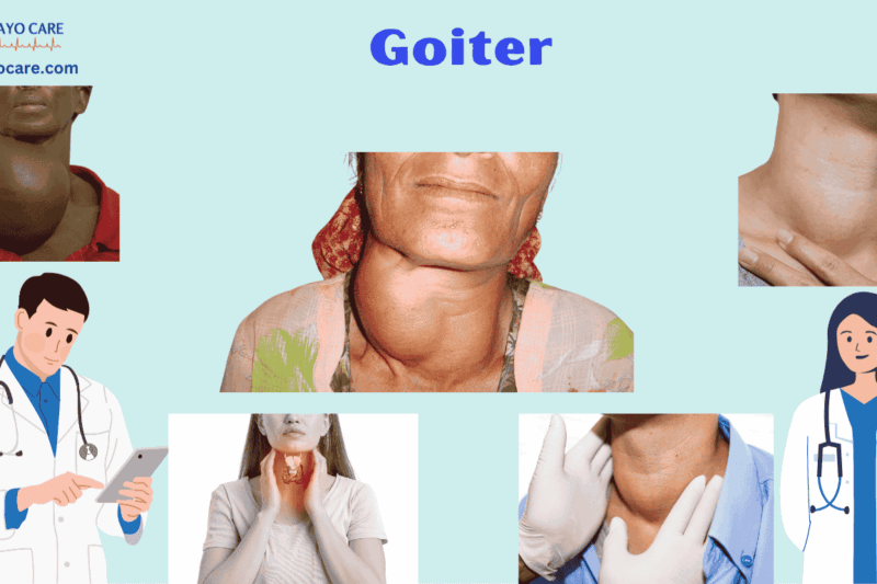 Goiter: Causes, Symptoms and Treatments