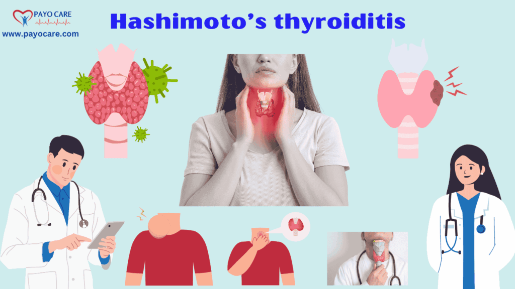 Hashimoto’s thyroiditis :Types, Causes, Symptoms, Prevention, Diagnosis & Treatment Hashimoto’s thyroiditis :Types, Causes, Symptoms, Prevention, Diagnosis & Treatment
