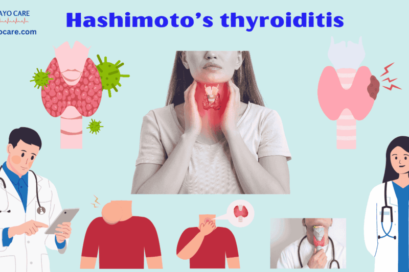 Hashimoto’s thyroiditis :Causes, Symptoms & Treatment