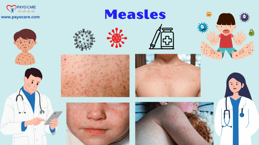 Measles: Causes, Symptoms, Prevention & Treatment