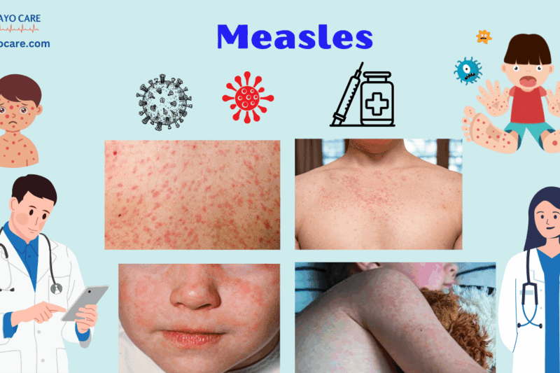 Measles: Causes, Symptoms, Prevention & Treatment