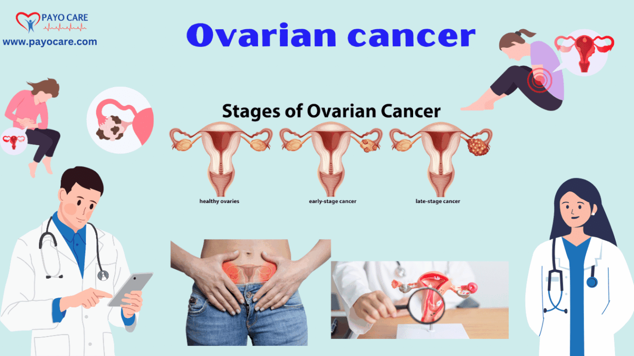 Ovarian Cancer: Causes, Symptoms, Prevention & Treatment