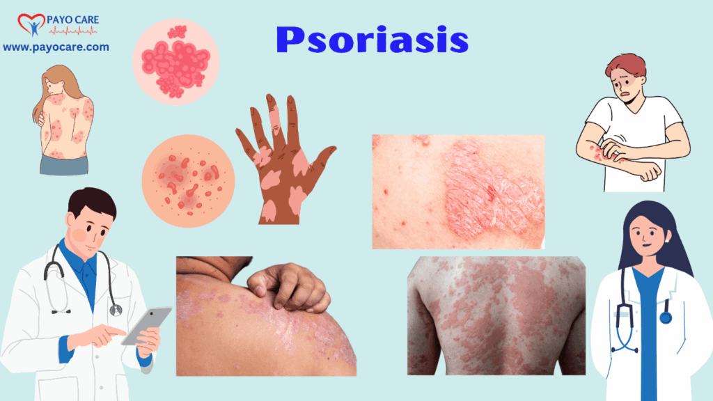 Psoriasis: Causes, Symptoms, Types, Prevention, and Treatment
