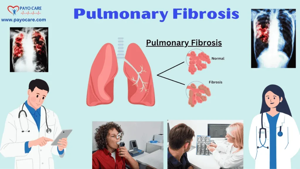 Pulmonary Fibrosis (1) Pulmonary Fibrosis (1)