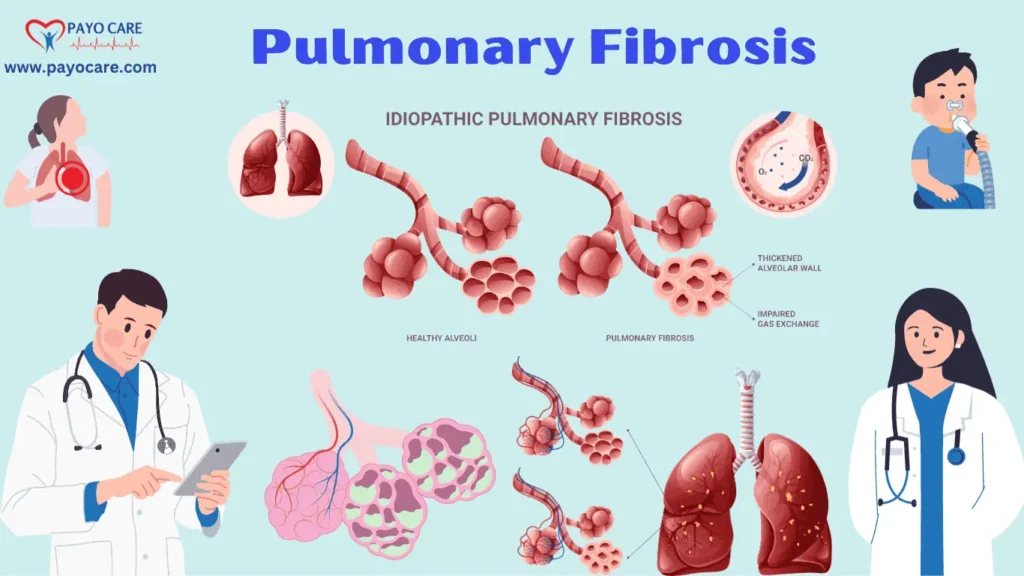 Pulmonary Fibrosis: Types, Causes, Symptoms & Treatments Pulmonary Fibrosis: Types, Causes, Symptoms & Treatments