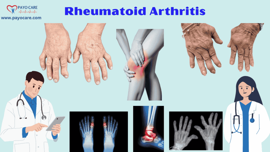 Rheumatoid Arthritis :Types, Causes, Symptoms, Prevention, Diagnosis & Treatment Rheumatoid Arthritis :Types, Causes, Symptoms, Prevention, Diagnosis & Treatment