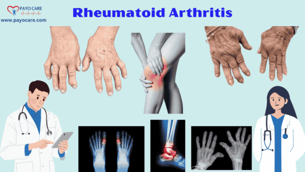 Rheumatoid Arthritis :Types, Causes, Symptoms, Prevention, Diagnosis & Treatment