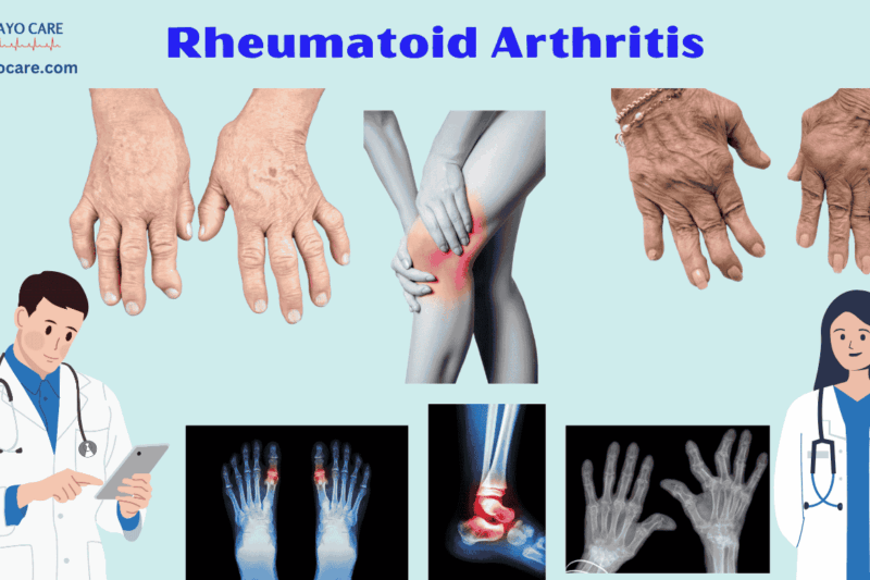 Rheumatoid Arthritis: Causes, Symptoms & Treatment