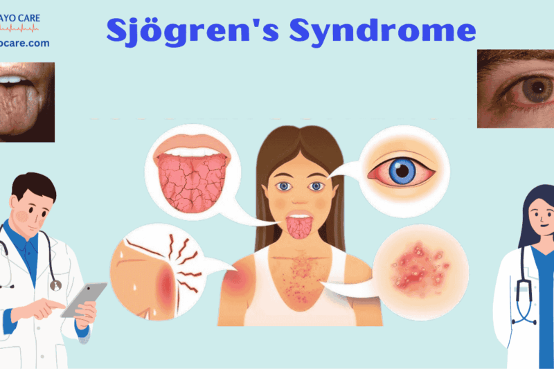 Sjögren’s Syndrome: Causes, Symptoms & Treatments
