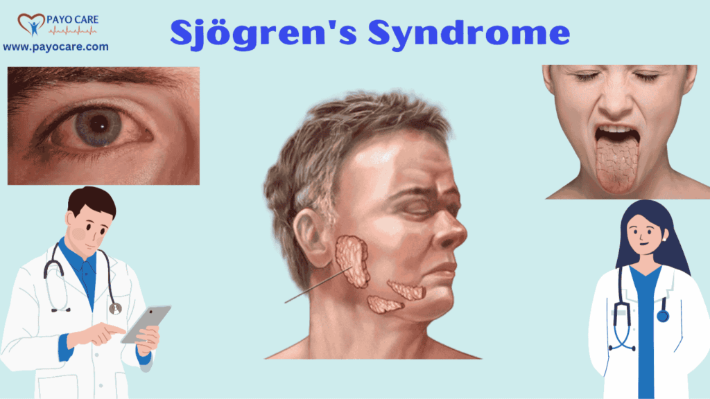 Sjögren's Syndrome: Causes, Symptoms  & preventions