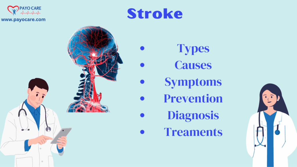 Stroke: Types, Causes, Symptoms, Prevention, Diagnosis, and Treatments Stroke: Types, Causes, Symptoms, Prevention, Diagnosis, and Treatments