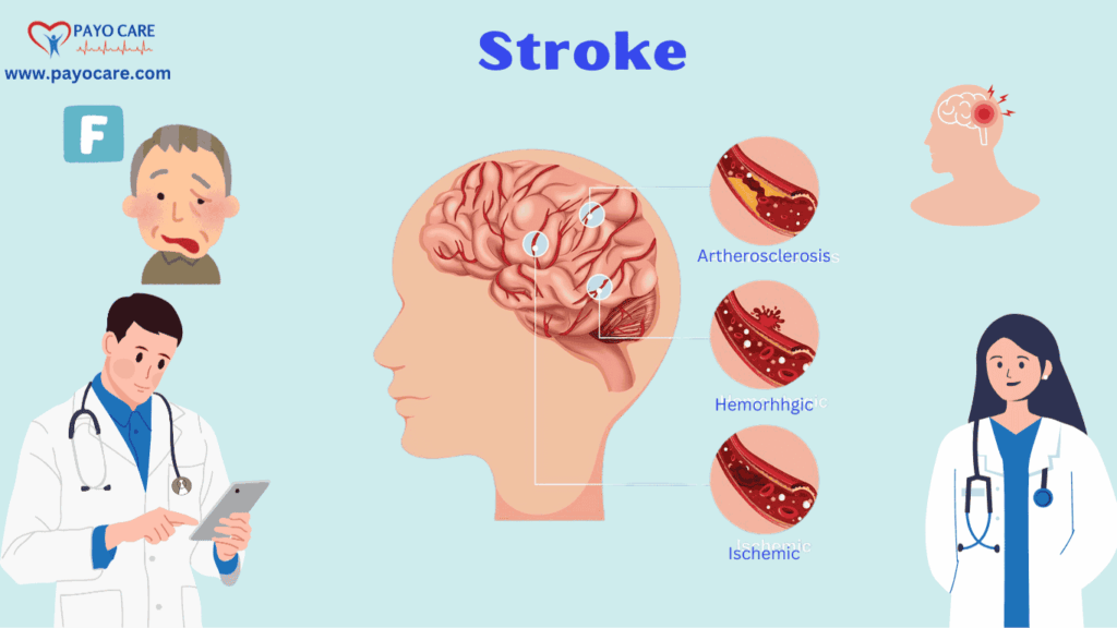 Stroke Causes and Symptoms Stroke Causes and Symptoms