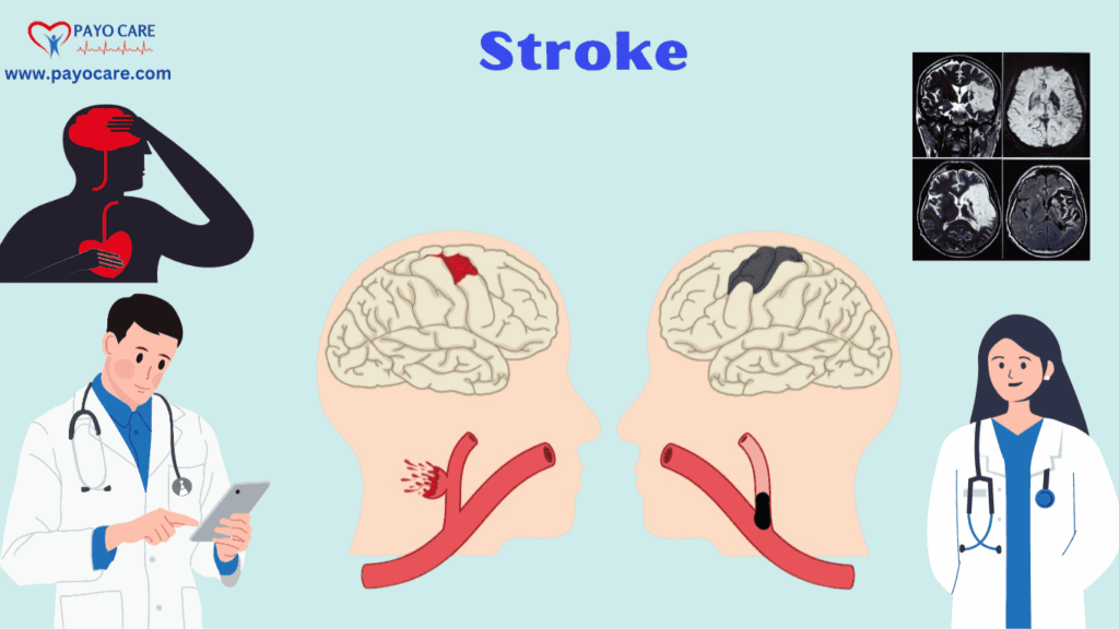 Stroke: Causes, Symptoms & Prevention Stroke: Causes, Symptoms & Prevention