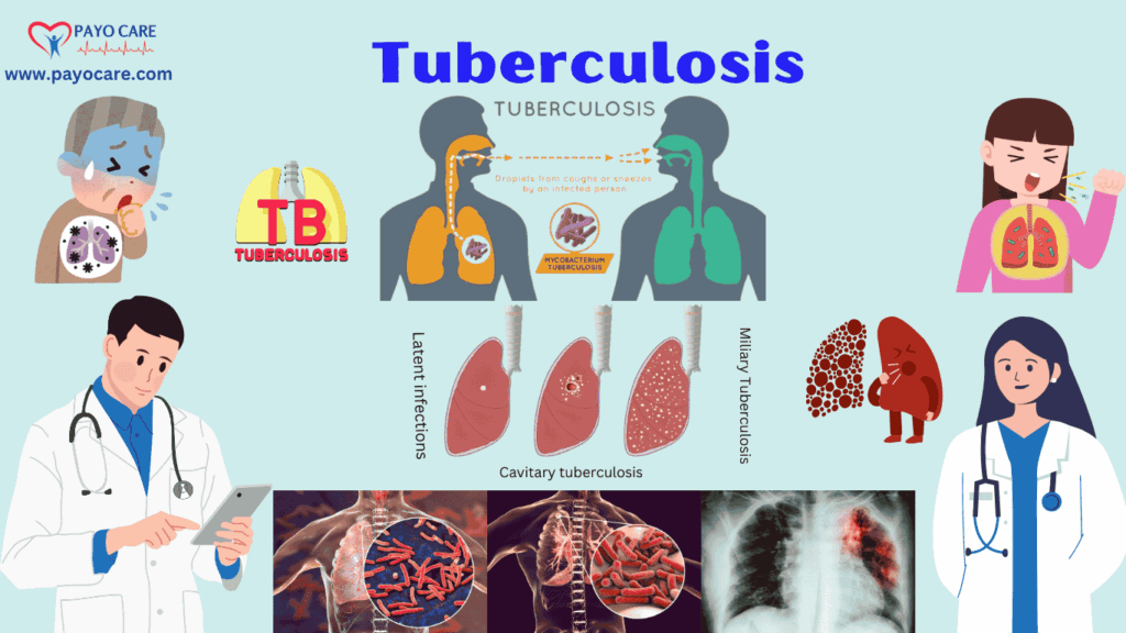 Tuberculosis: Types, Causes, Symptoms, Prevention, Diagnosis & Treatment