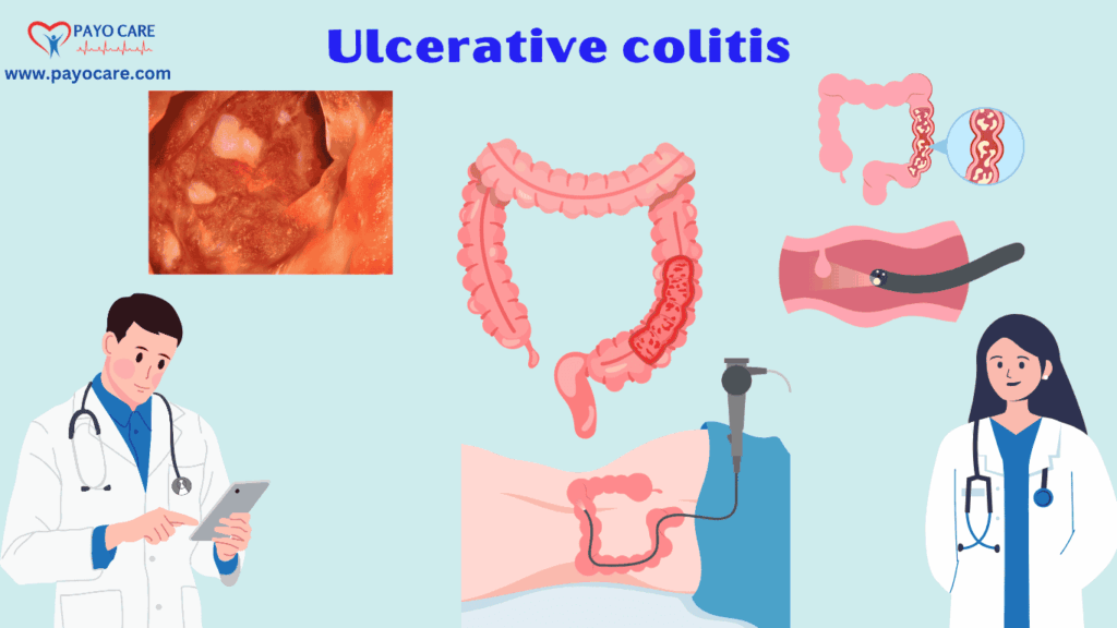 Ulcerative Colitis: Types, Causes, Symptoms, Prevention, Diagnosis & Treatment
