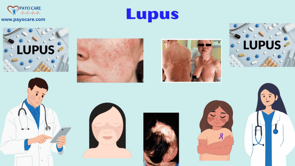 Lupus :Types, Causes, Symptoms, Prevention, Diagnosis & Treatment