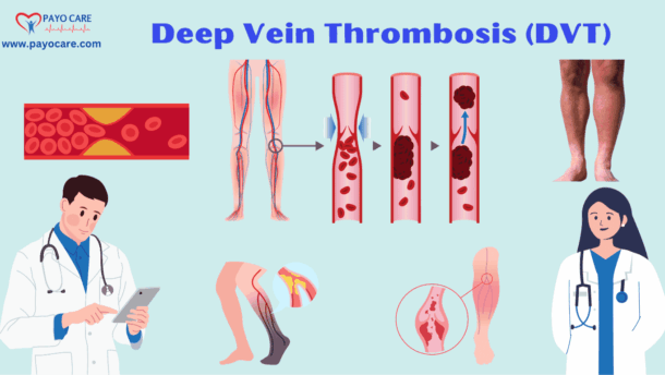 Deep Vein Thrombosis (DVT): Types, Causes, Symptoms, and Treatments