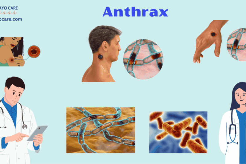 Anthrax :Causes, Symptoms and Treatment