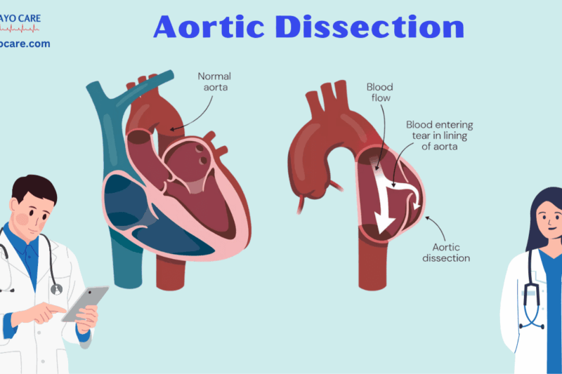 Aortic Dissection: Causes, Symptoms and Treatments