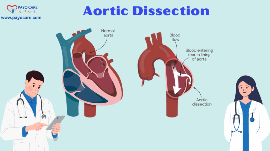 Aortic Dissection: Types, Causes, Symptoms, Prevention and Treatment