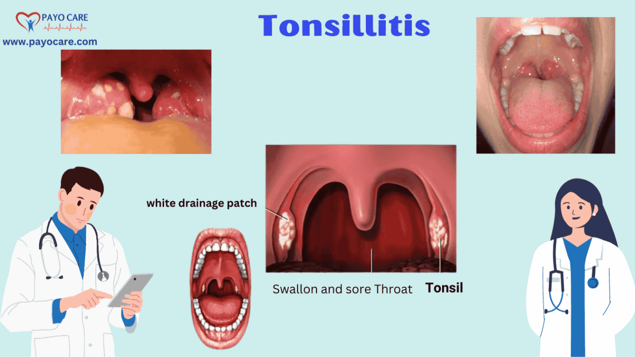 Tonsillitis: Types, Causes, Symptoms, Prevention, and Treatment