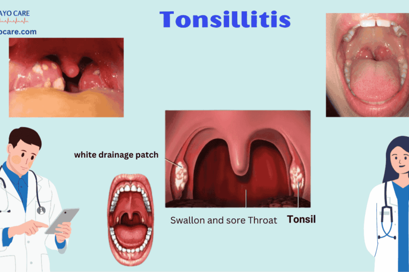 Tonsillitis: Causes, Symptoms, Preventions and Treatment