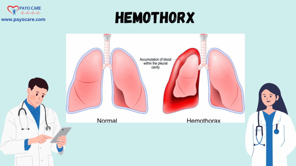 Hemothorax: Types, Causes, Symptoms, Prevention, and Treatment