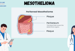 Mesothelioma :Types, Causes, Symptoms, Prevention, Diagnosis, and Treatment