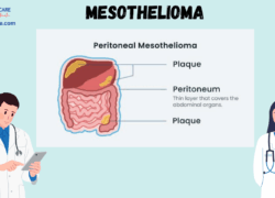 Mesothelioma :Types, Causes, Symptoms, Prevention, Diagnosis, and Treatment