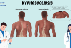 Kyphoscoliosis: Causes, Symptoms, Prevention, Diagnosis, and Treatment