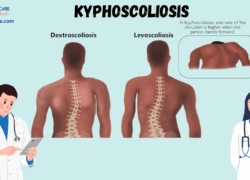 Kyphoscoliosis: Causes, Symptoms, Prevention, Diagnosis, and Treatment
