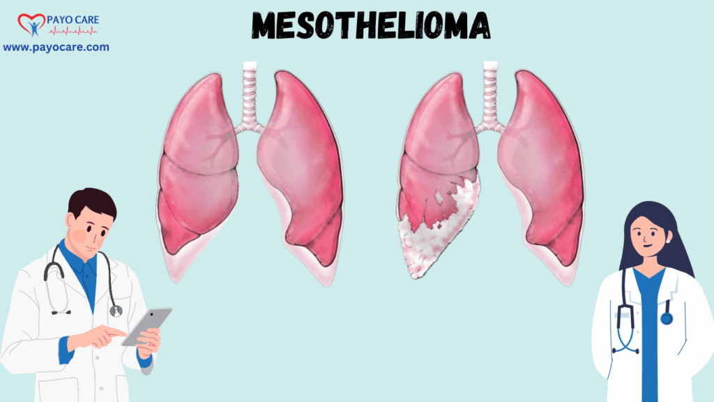 Mesothelioma :Types, Causes, Symptoms, Prevention, Diagnosis, and Treatment Mesothelioma :Types, Causes, Symptoms, Prevention, Diagnosis, and Treatment