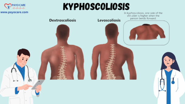 Kyphoscoliosis: Causes, Symptoms, Prevention, Diagnosis, and Treatment