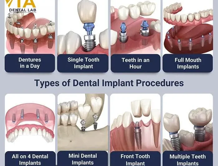 How To Find Cheap Dental Implant