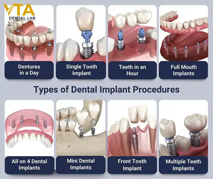 dental-implants-cost-2